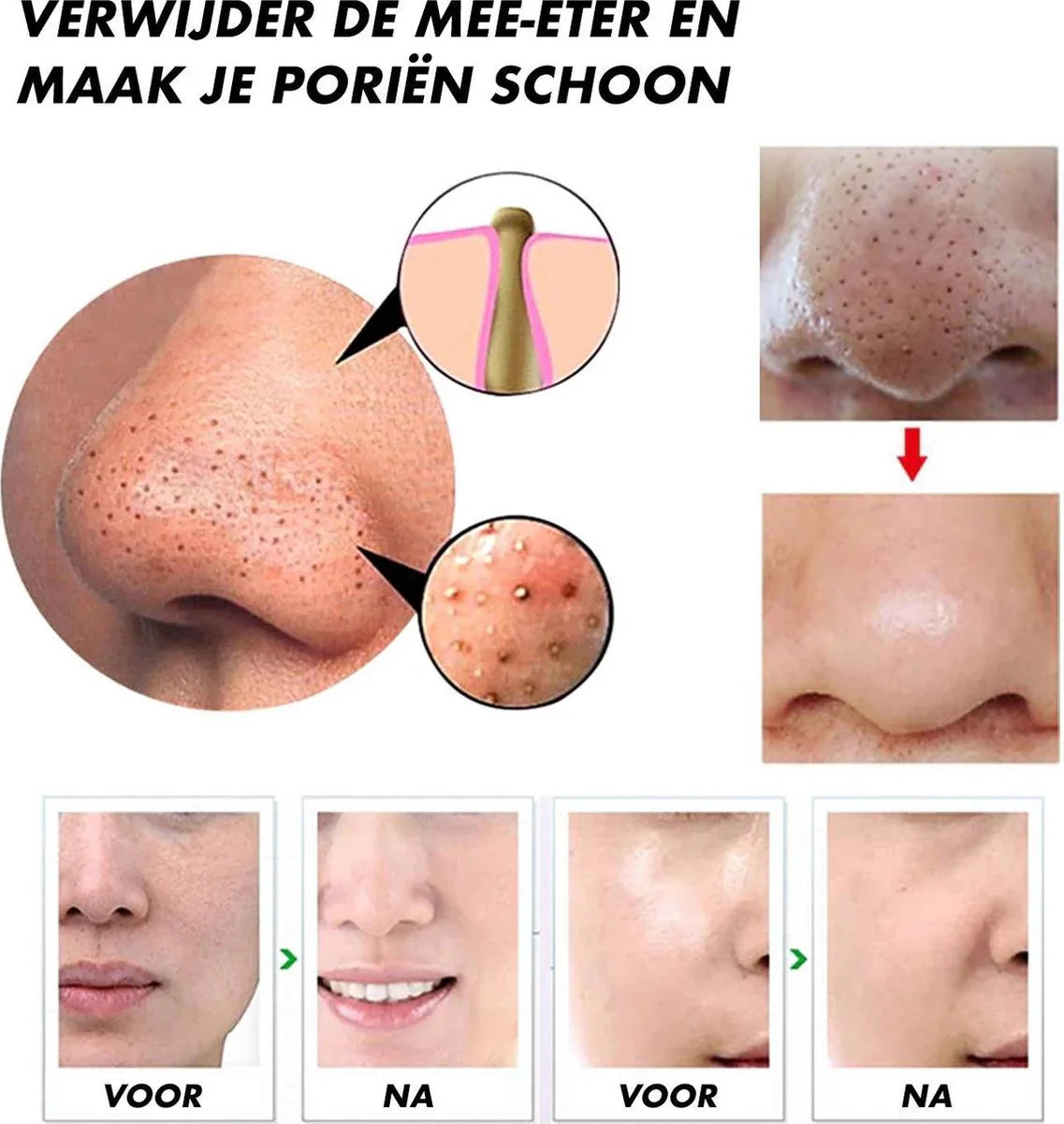 Blackhead Remover Vacuum – Multifunctional Pore Cleaner