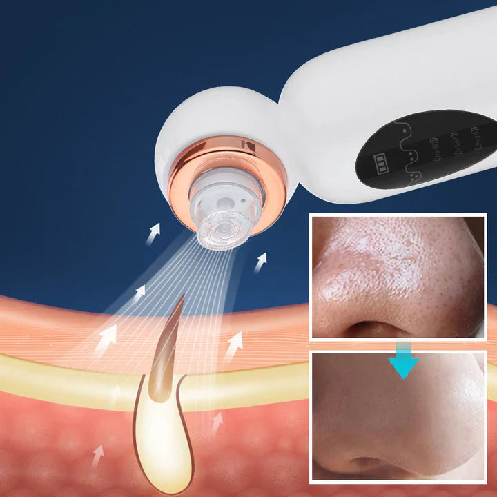 Blackhead Remover & Hydrodermabrasion Device – Deep Pore Cleansing with Vacuum Technology