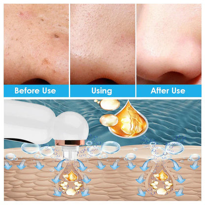 Blackhead Remover & Hydrodermabrasion Device – Deep Pore Cleansing with Vacuum Technology