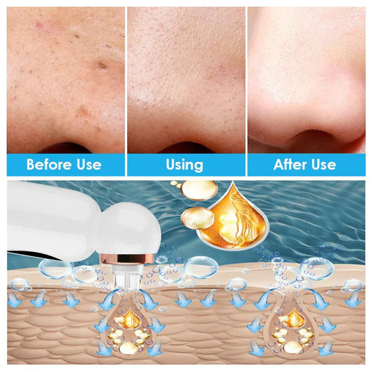 Blackhead Remover & Hydrodermabrasion Device – Deep Pore Cleansing with Vacuum Technology
