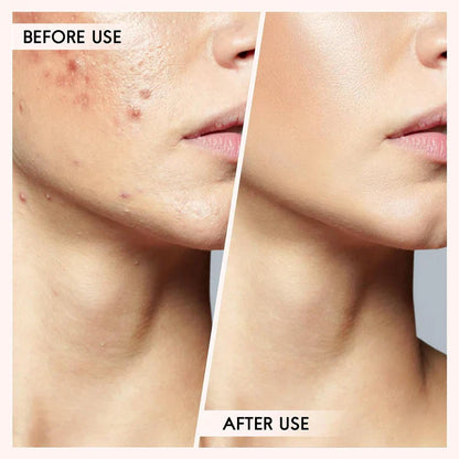 Professional Blackhead and Pimple Removal Set for Clear Skin