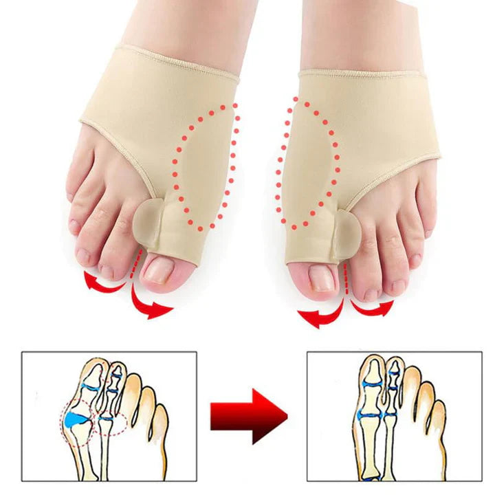Hallux Valgus Corrective Support (1 Pair) – Effective Protection for Your Feet