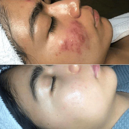 High-Frequency Skin Therapy Device for Smooth Skin