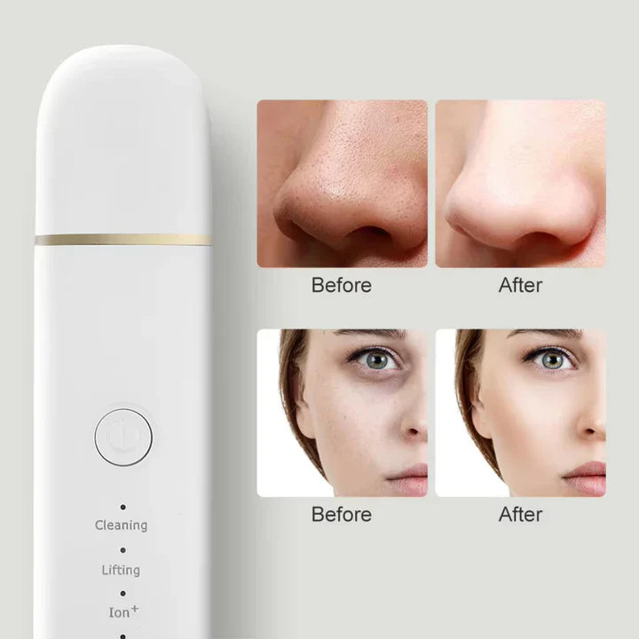 Ultrasonic Skin Scrubber for Deep Cleansing – Pore Cleaner & Facial Peeling with Ion Technology